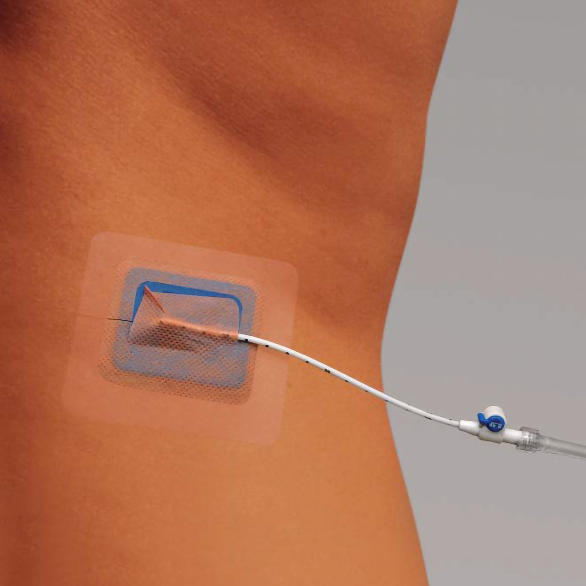Catheter Fixation Device Stayfix Large, 12 to 22 Fr.